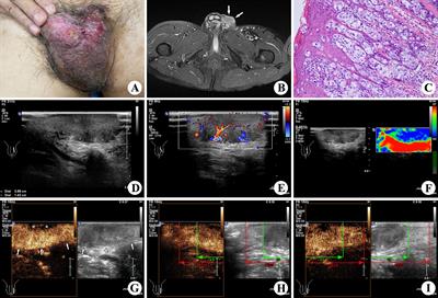 Extramammary Paget’s Disease in the Genital Area of a Male: A Case Report and Review of the Literature